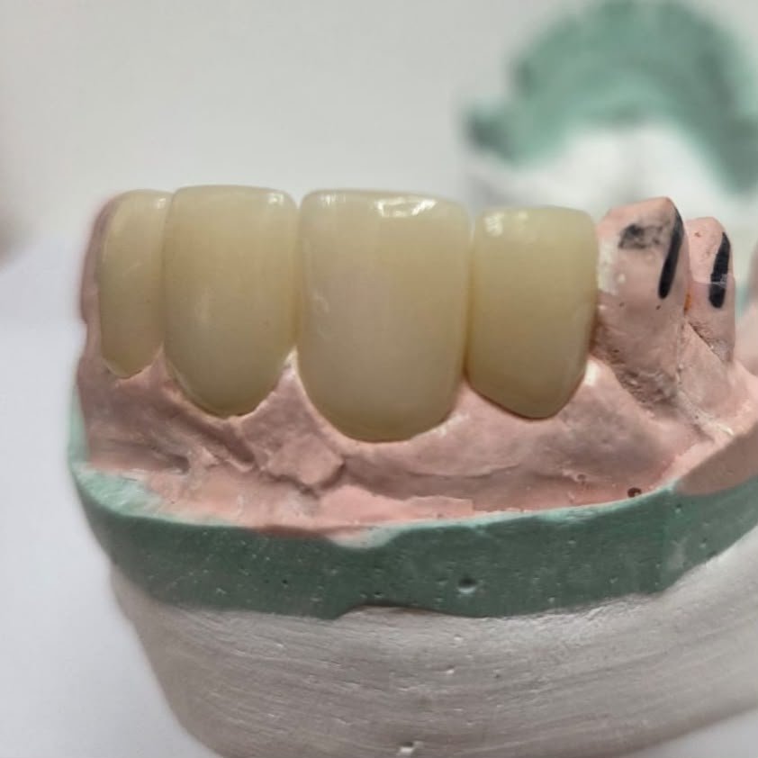 Estructura de porcelana dental LDent